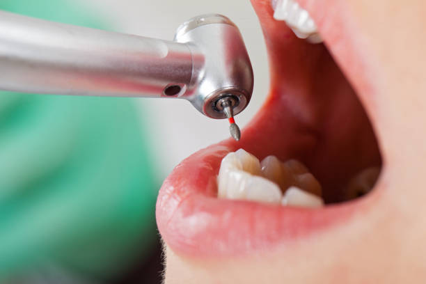 Best Emergency Dentist for Knocked-Out Tooth in Knox, IN